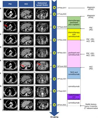 Treatment of Multiple Primary Malignancies With PD-1 Inhibitor Camrelizumab: A Case Report and Brief Literature Review